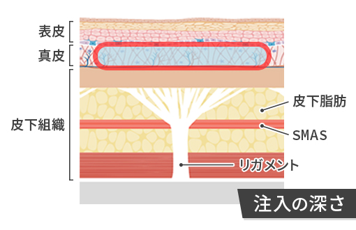 プルリアル シルクの注入の深さ