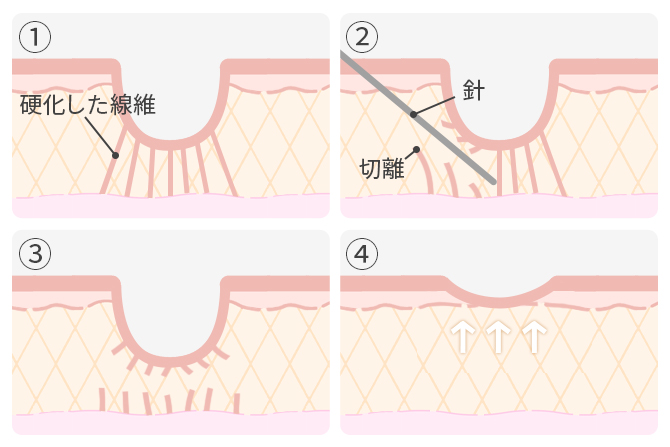 凹みの原因となる固くなった線維を針で切り離す