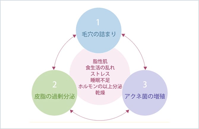 ニキビのできる三大要因