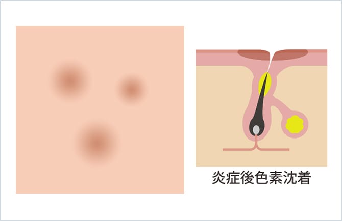 ニキビ・ニキビ痕治療 | 美容整形外科のジョウクリニック
