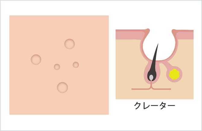 クレーター状ニキビ痕のイラスト