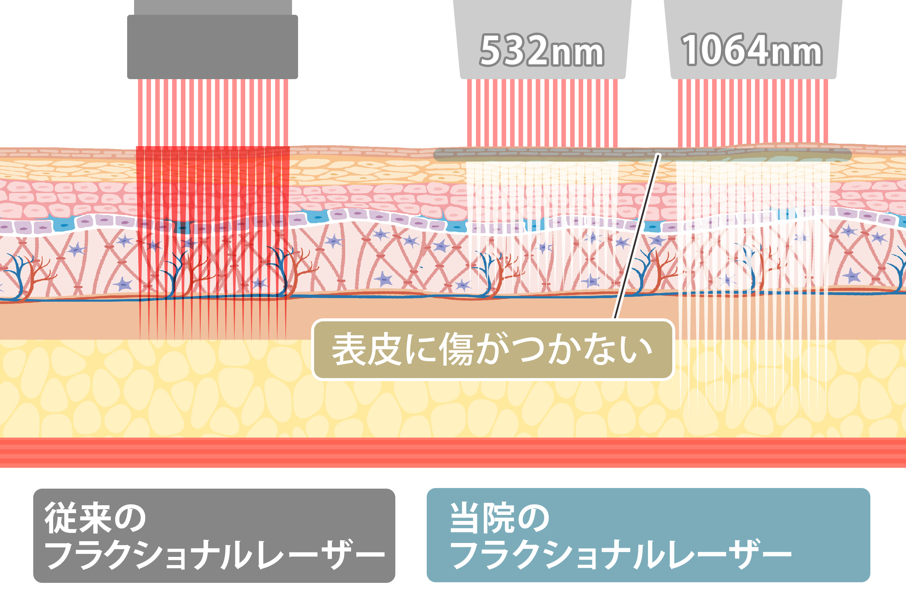 従来のフラクショナルレーザー当院のフラクショナルレーザー比較