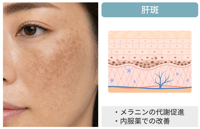 低刺激ケアで色ムラのない肌へ