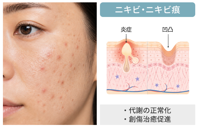 炎症ニキビからニキビ痕まで幅広く改善