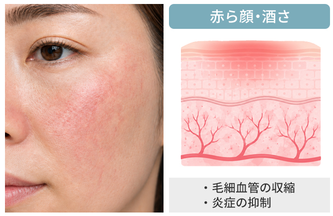 赤みの原因を見極め症状に合った治療をご提案