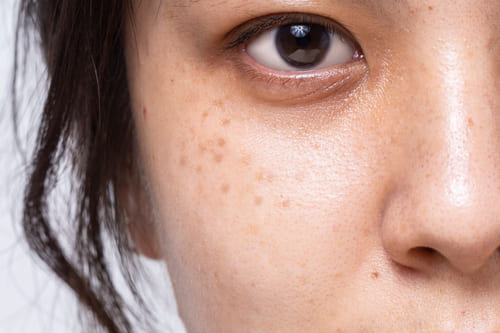 シミ・そばかすを撃退!憧れの美白お肌に