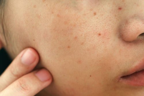 くすみを改善し、さらに綺麗なお肌へ