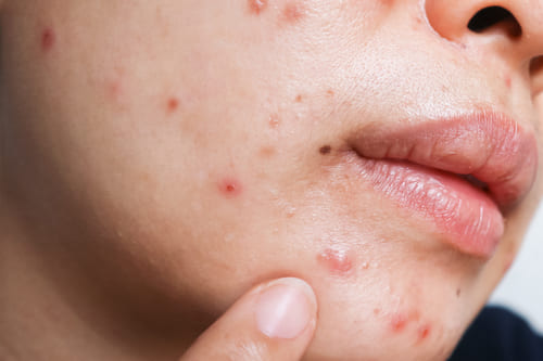ニキビ・ニキビ痕の対策に