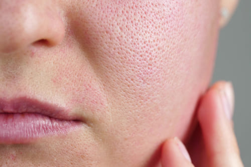 気になる毛穴の改善