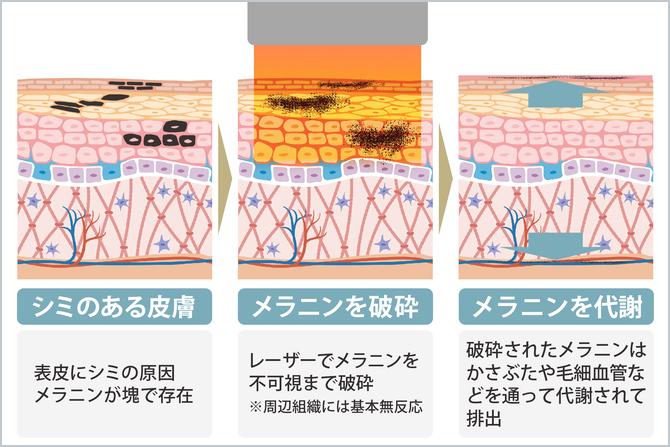 レーザーシミ取りの施術
