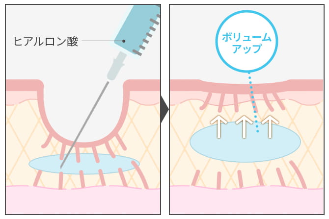ヒアルロン酸注入×サブシジョン