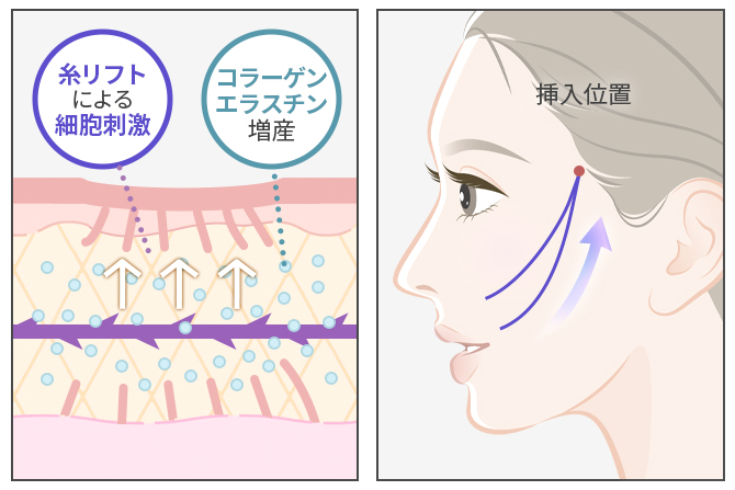 糸リフト×サブシジョン