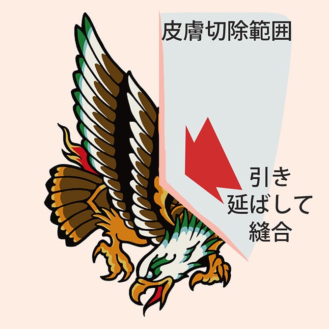 切開によるタトゥー除去のイラスト
