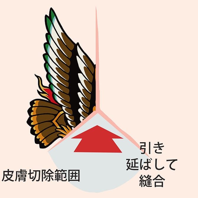 切開によるタトゥー除去のイラスト