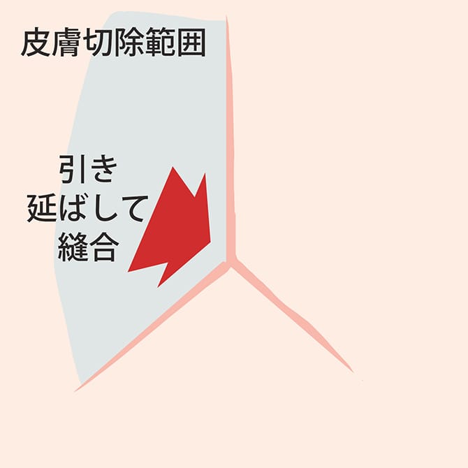 切開によるタトゥー除去のイラスト