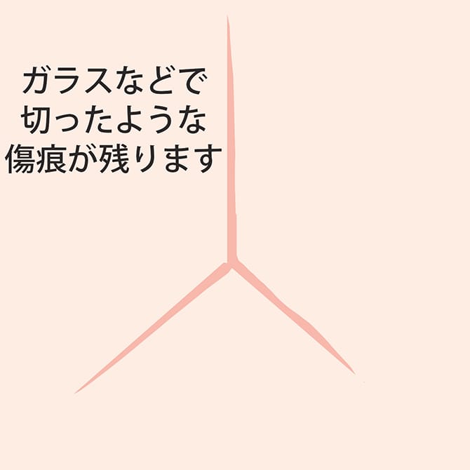 切開によるタトゥー除去後、ガラスで切ったような傷痕が残るイラスト