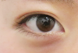 【10代女性】眼瞼下垂（挙筋短縮部分切開法）＋脂肪取り術｜3ヵ月後 after