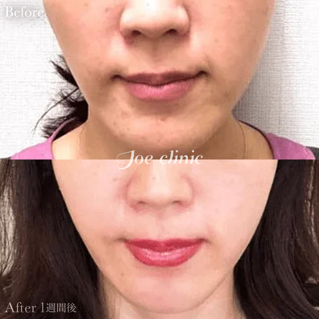 【40代女性】水光注射（Vital Injector）｜1週間後