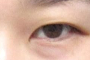 【30代女性】二重部分切開法 （二重マイクロ法）＋脂肪取り術｜3ヵ月後 before