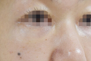ナノファット注入 (目の下) before