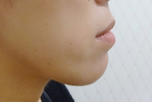 【30代女性】超音波骨削り術＋顎プロテーゼ挿入＋ナノファット注入｜1ヵ月半後 before