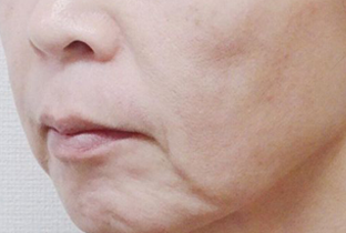 【50代女性】フェイスリフト｜1ヵ月後 before