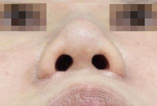 小鼻縮小術 after