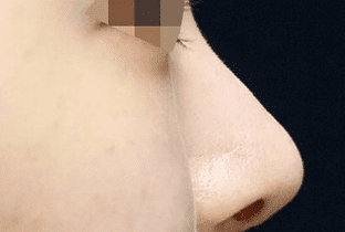 【女性】耳介軟骨移植、鼻尖縮小、ハンプ削り治療 (鼻骨骨切り術)(1ヵ月後) after