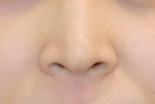 小鼻縮小術 、鼻尖縮小術 before
