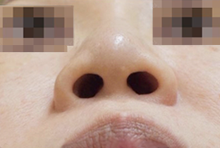 小鼻縮小術 before