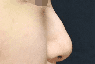 【女性】耳介軟骨移植、鼻尖縮小、ハンプ削り治療 (鼻骨骨切り術)(1ヵ月後) before