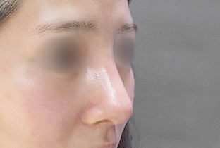 【20代女性】鼻フルコース（鼻複合自家組織移植術）＋超音波鼻骨骨削り術＋鼻プロテーゼ挿入隆鼻術（I型）｜1ヵ月後 after