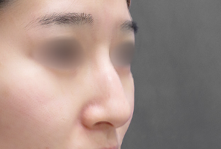 【20代女性】鼻フルコース（鼻複合自家組織移植術）＋超音波鼻骨骨削り術＋鼻プロテーゼ挿入隆鼻術（I型）｜1ヵ月後 before