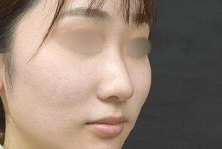 鼻ヒアルロン酸注入隆鼻術 before