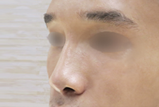 【10代男性】鼻ヒアルロン酸注入隆鼻術 1cc│直後 after