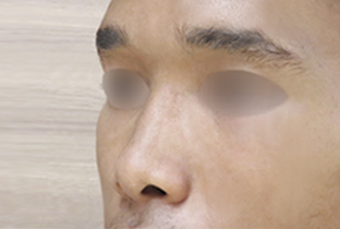 【10代男性】鼻ヒアルロン酸注入隆鼻術 1cc│直後 before