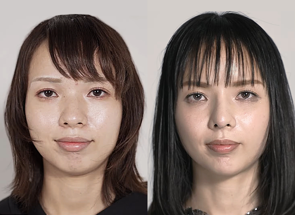 ぴょんすさんの症例写真（BeforeAfter）