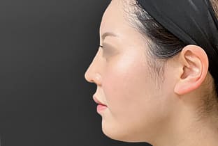 【20代女性】鼻フルコース（鼻複合自家組織移植術）＋鼻プロテーゼ挿入隆鼻術＋貴族手術｜1年後 after