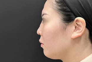 【20代女性】鼻フルコース（鼻複合自家組織移植術）＋鼻プロテーゼ挿入隆鼻術＋貴族手術｜1年後 before