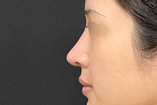 【20代女性・他院修正】他院鼻プロテーゼ入替+鼻先異物除去+鼻フルコース(鼻複合自家組織移植術)|1ヵ月後 after