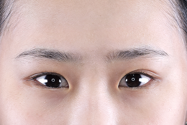 【10代女性】ジョウクリ式二重埋没法2点留め｜1ヵ月後 before