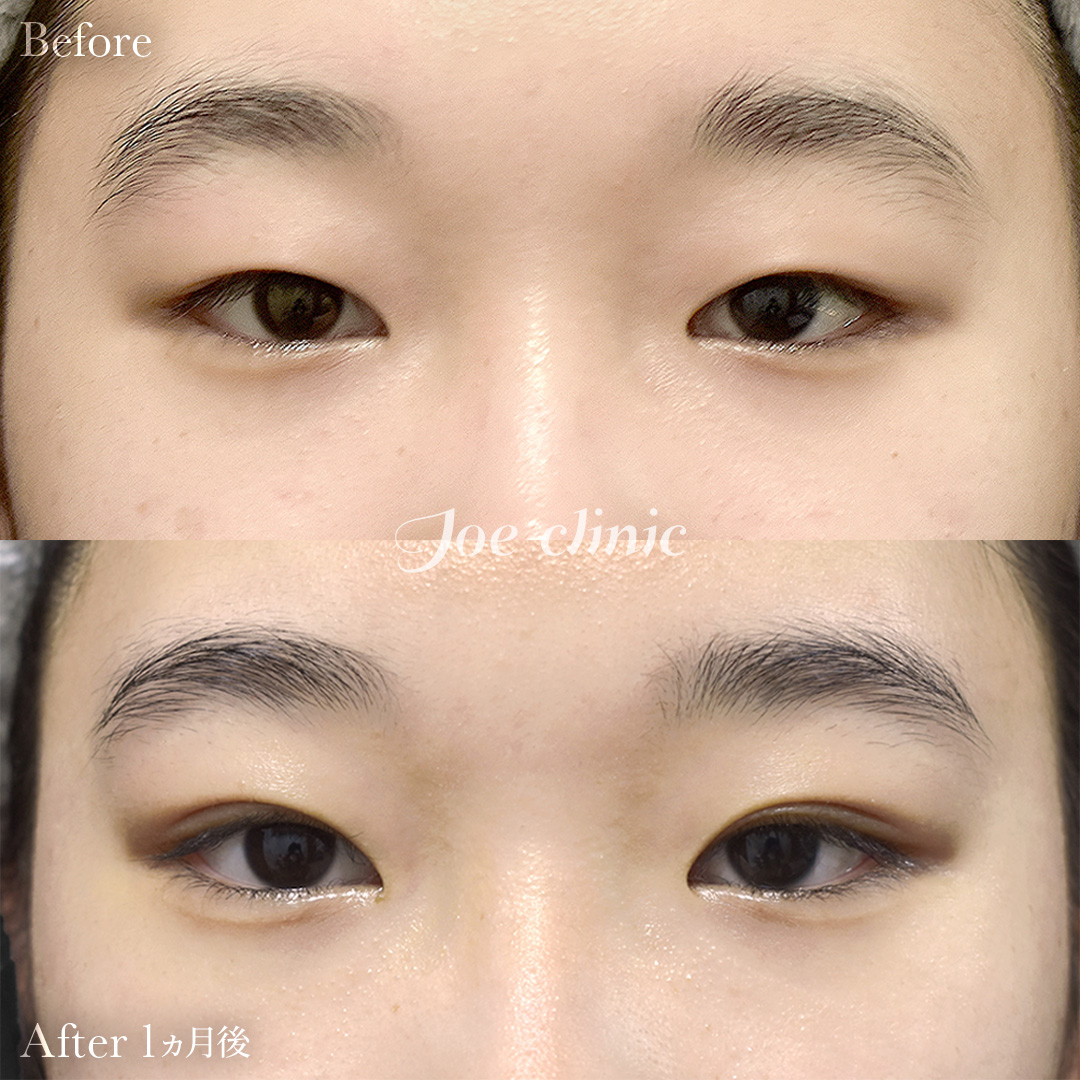 【10代女性】ジョウクリ式二重埋没法3点留め｜1ヵ月後