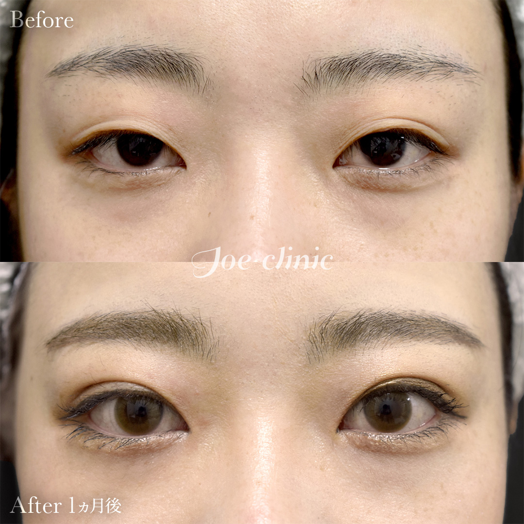 【20代女性】ジョウクリ式二重埋没法3点留め｜1ヵ月後