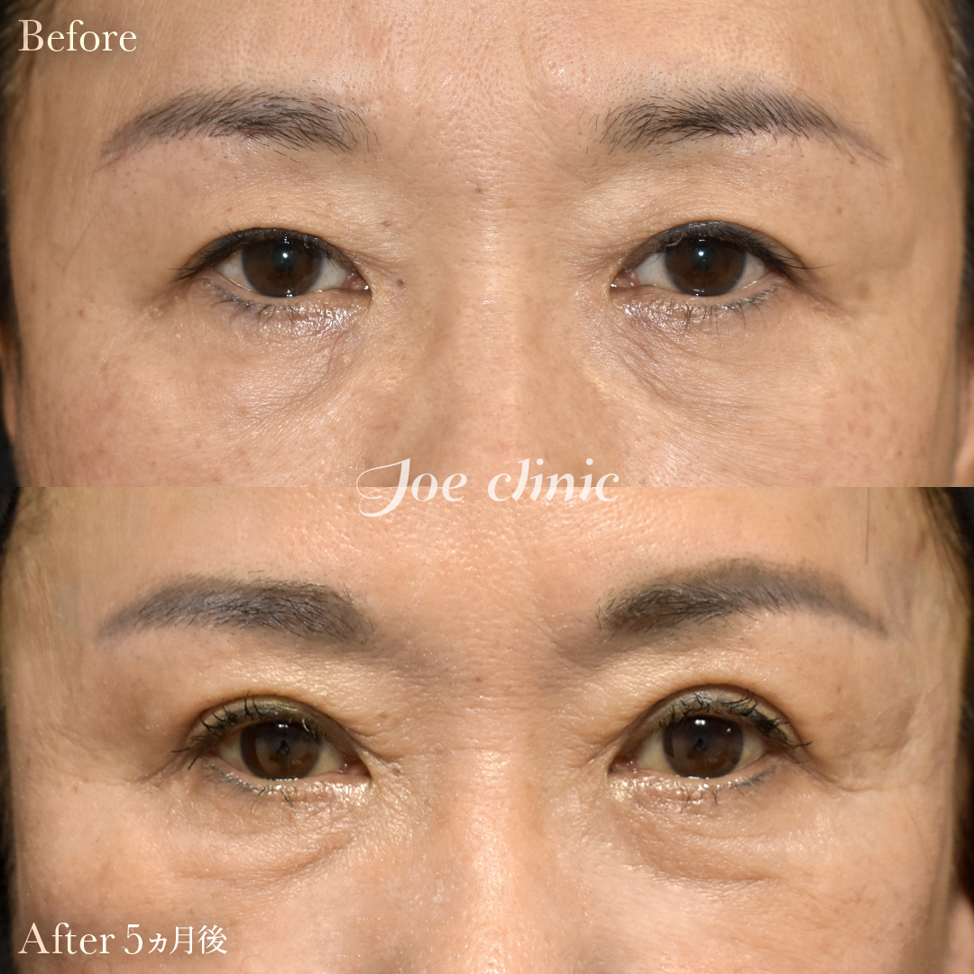 【50代女性】二重全切開法｜5ヵ月後