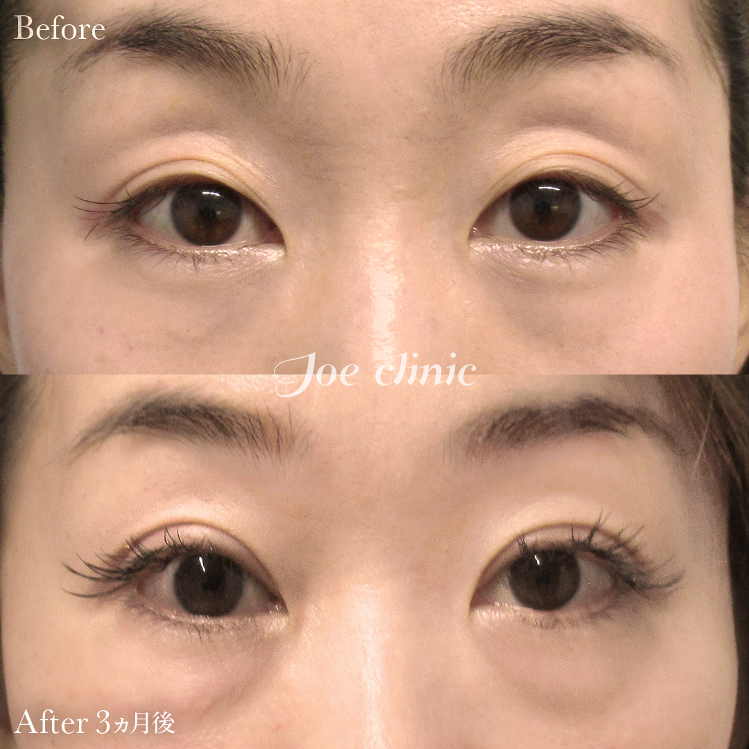 【30代女性】眼瞼下垂（挙筋短縮全切開法）＋たるみ取り術｜3ヵ月後