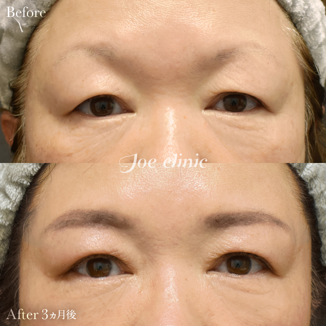 【60代女性】眉下切開術（3ヵ月後）