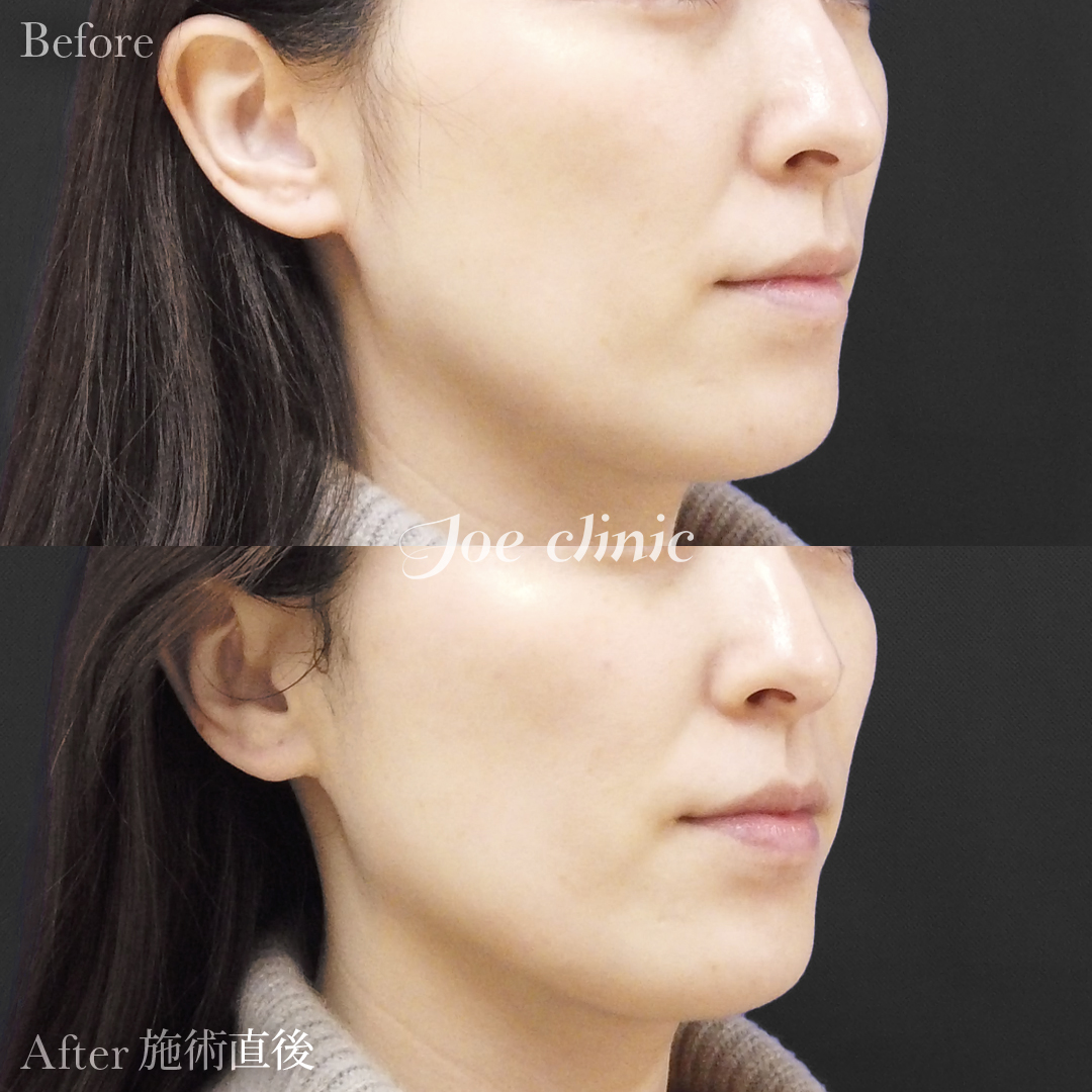 【30代女性】HIFU治療（ベレーザプロ）｜施術直後