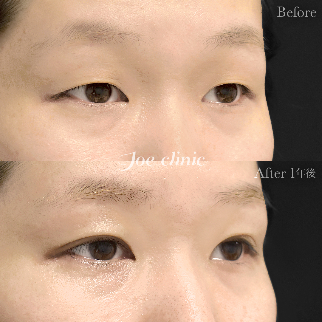 【30代女性】二重部分切開法（二重マイクロ法）＋脂肪取り術｜1年後