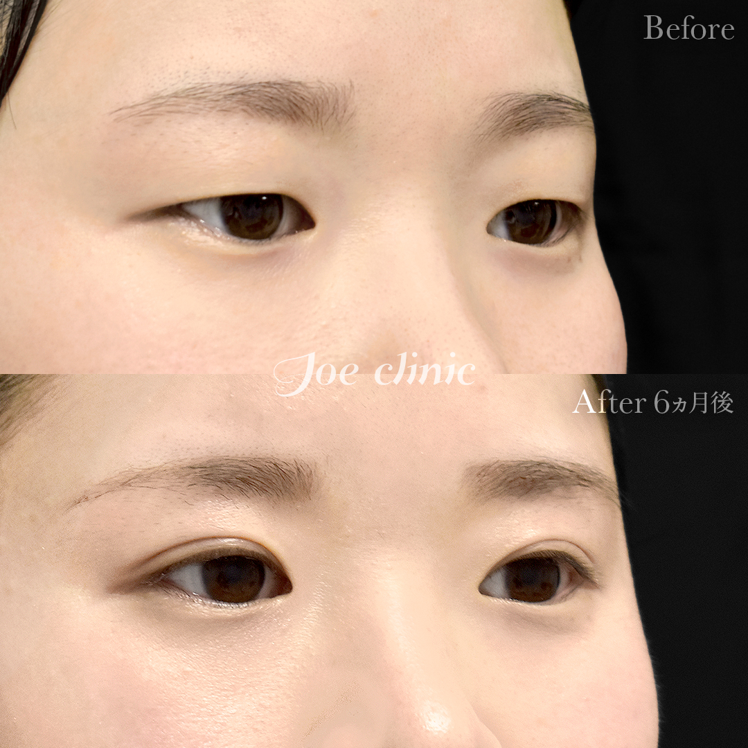 【20代女性】二重部分切開法（二重マイクロ法）＋脂肪取り術｜6ヵ月
