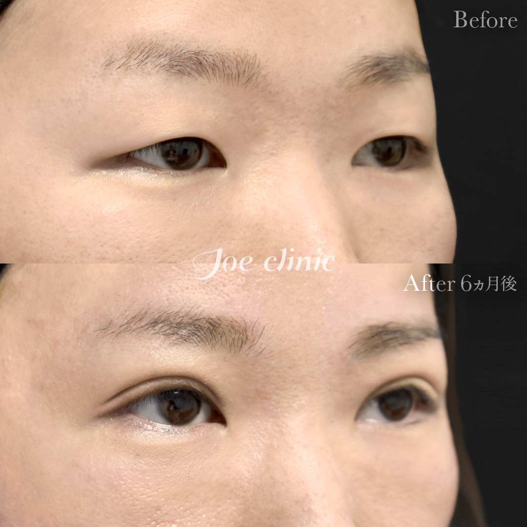 【30代女性】眼瞼下垂（挙筋短縮部分切開法）＋脂肪取り術｜6ヵ月後